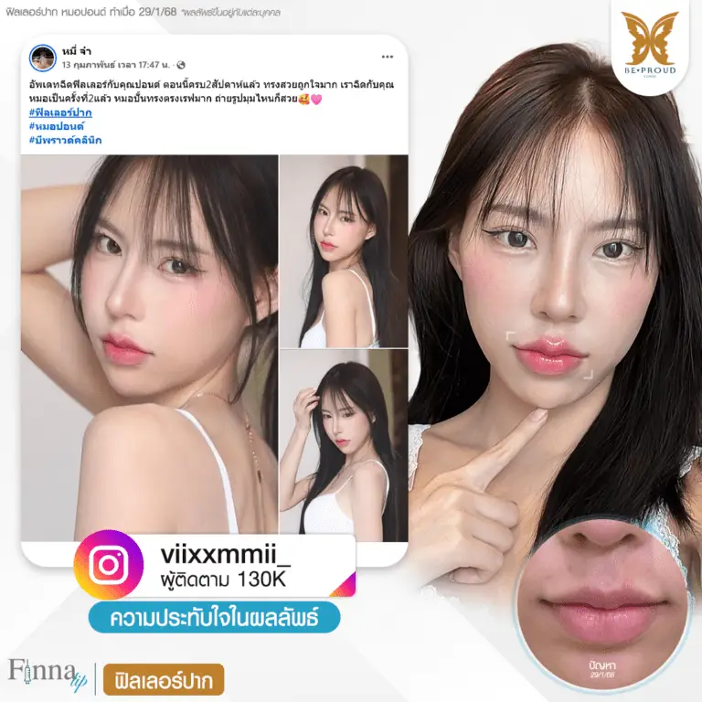 รีวิวความประทับใจหัตถการฟิลเลอร์ปากคุณ @viixxmmii_ ทรงปากสวยอวบอิ่ม หลังทำฟิลเลอร์ปากกับหมอปอนด์ ที่บีพราวด์คลินิก