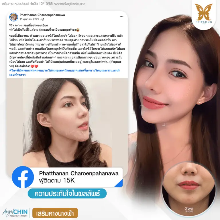 รีวิวความประทับใจศัลยกรรมเสริมคางนางฟ้า แสดงภาพเปรียบเทียบก่อนทำและหลังทำศัลยกรรม กับหมอปอนด์ ที่บีพราวด์คลินิก