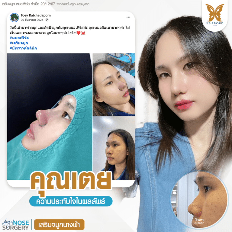 รีวิวความประทับใจศัลยกรรมเสริมจมูกนางฟ้า แสดงภาพเปรียบเทียบก่อนทำและหลังทำศัลยกรรม กับหมอเฟิร์ส ที่บีพราวด์คลินิก