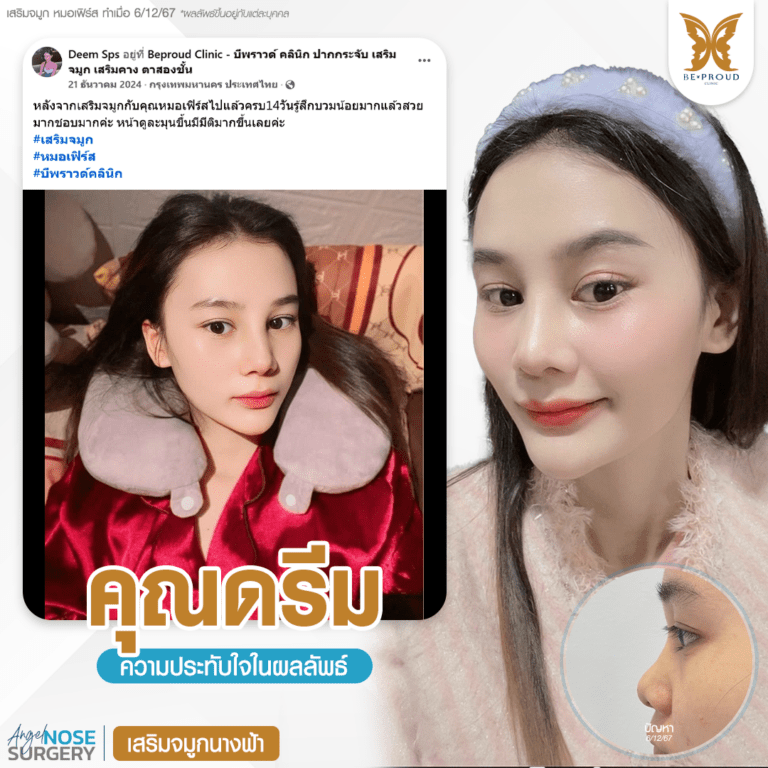 รีวิวความประทับใจศัลยกรรมเสริมจมูกนางฟ้า เปรียบเทียบภาพก่อนทำและหลังทำศัลยกรรม กับหมอเฟิร์ส ที่บีพราวด์คลินิก