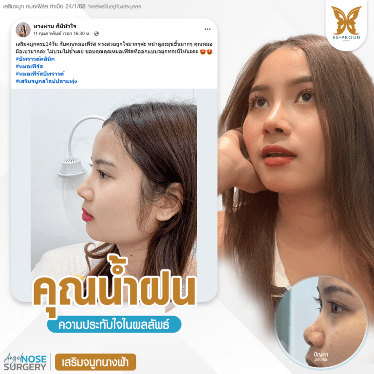 รีวิวความประทับใจศัลยกรรมเสริมจมูกนางฟ้า แสดงภาพเปรียบเทียบก่อนทำและหลังทำศัลยกรรม กับหมอเฟิร์ส ที่บีพราวด์คลินิก