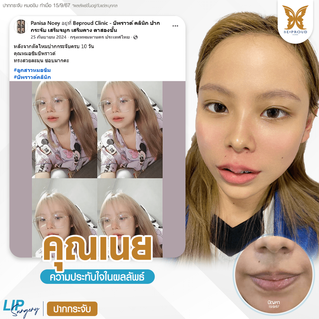 รีวิวความประทับใจศัลยกรรมปากกระจับ หลังทำ 10 วัน กับหมอขิม ที่บีพราวด์คลินิก