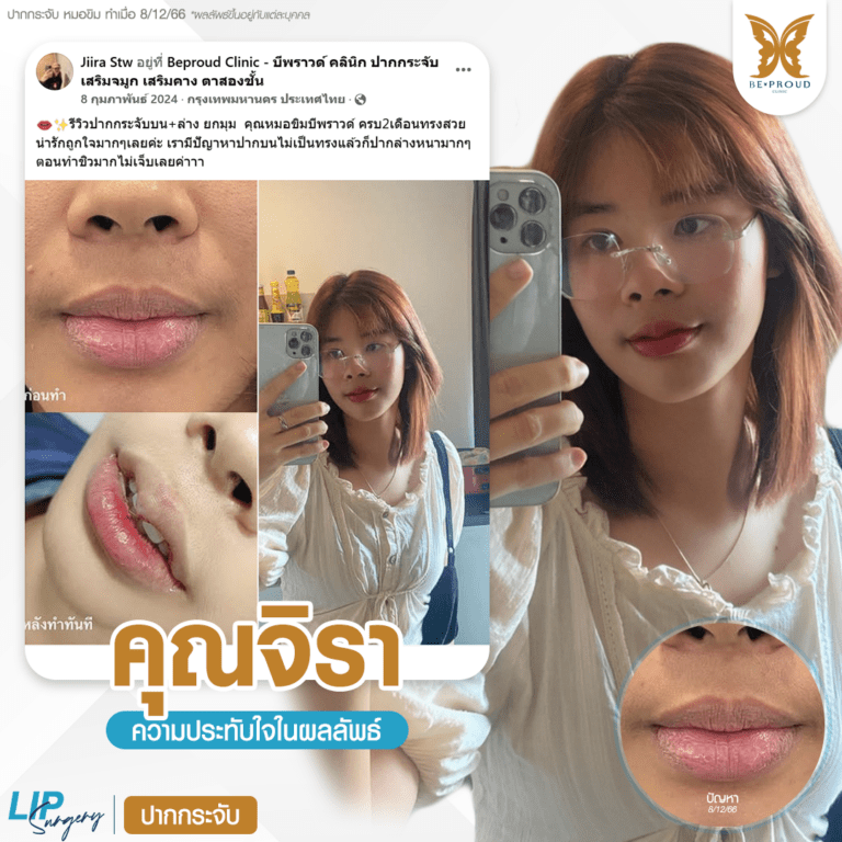 รีวิวความประทับใจศัลยกรรมปากกระจับบนล่าง ยกมุมปาก เปรียบเทียบภาพก่อนทำและหลังทำศัลยกรรม กับหมอขิม ที่บีพราวด์คลินิก