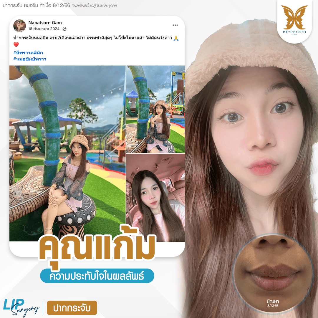 รีวิวความประทับใจศัลยกรรมปากกระจับ แสดงภาพเปรียบเทียบก่อนทำและหลังทำศัลยกรรม กับหมอขิม ที่บีพราวด์คลินิก