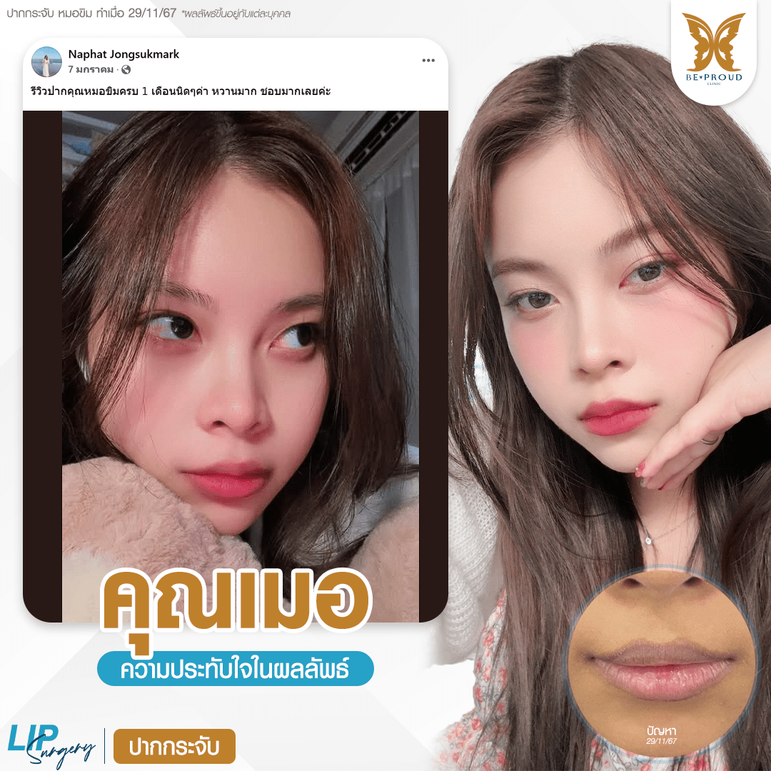 รีวิวความประทับใจศัลยกรรมปากกระจับ แสดงภาพเปรียบเทียบก่อนทำและหลังทำศัลยกรรม กับหมอขิม ที่บีพราวด์คลินิก