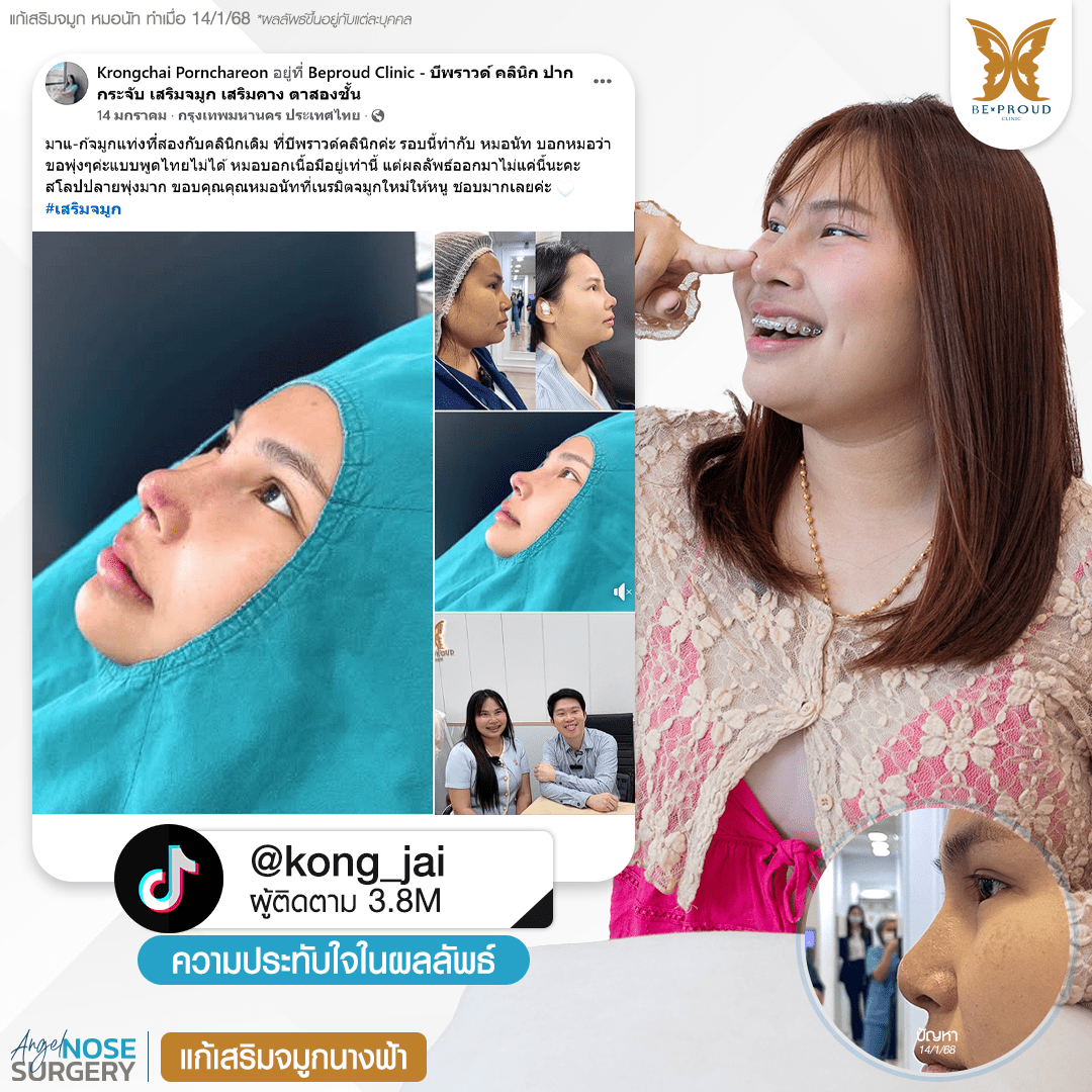 รีวิวความประทับใจศัลยกรรมเสริมจมูกนางฟ้าของอินฟลูเอนเซอร์คุณ @kong_jai แสดงภาพก่อนทำและหลังทำจมูก กับหมอนัท ที่บีพราวด์คลินิก