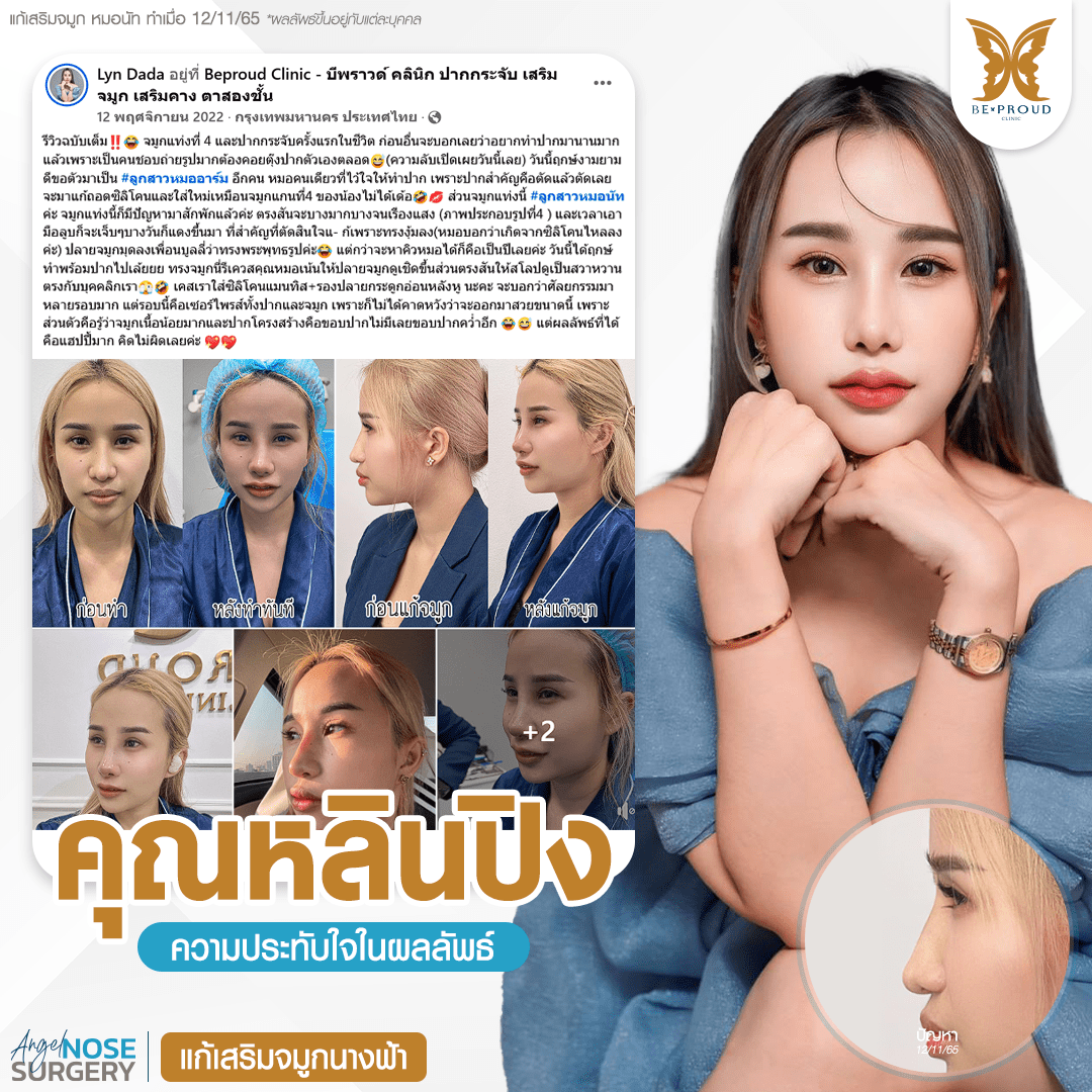 รีวิวความประทับใจศัลยกรรมแก้จมูก เสริมจมูกนางฟ้า แสดงภาพก่อนและหลังทำจมูก กับหมอนัท ที่บีพราวด์คลินิก