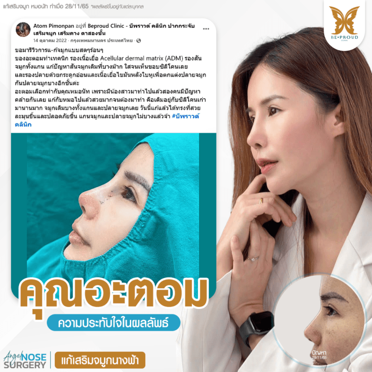 รีวิวความประทับใจศัลยกรรมเสริมจมูก แก้จมูกนางฟ้า เปรียบเทียบภาพก่อนทำและหลังทำศัลยกรรม กับหมอนัท ที่บีพราวด์คลินิก