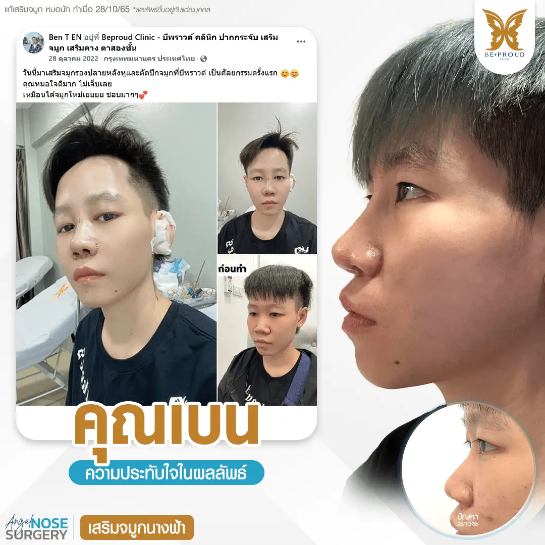 รีวิวความประทับใจศัลยกรรมเสริมจมูกนางฟ้า แสดงภาพก่อนทำและหลังทำศัลยกรรม กับหมอนัท ที่บีพราวด์คลินิก