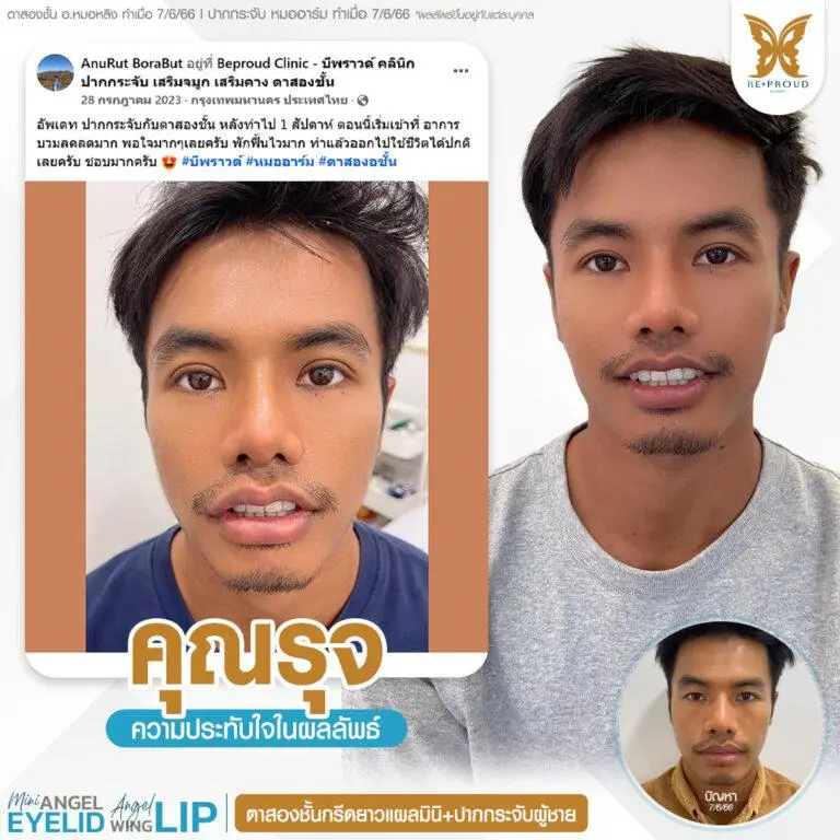 รีวิวความประทับใจศัลยกรรมตาสองชั้นกรีดยาวแผลมินิ และปากกระจับผู้ชาย เปรียบเทียบภาพก่อนทำและหลังทำศัลยกรรม ที่บีพราวด์คลินิก