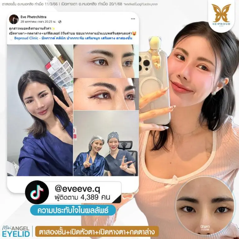 รีวิวความประทับใจศัลยกรรมตาสองชั้น เปิดหัวตา เปิดหางตา กดตาล่าง คุณ @eveeve.q แสดงภาพก่อนทำและหลังทำศัลยกรรม กับอ.หมอหลิง ที่บีพราวด์คลินิก