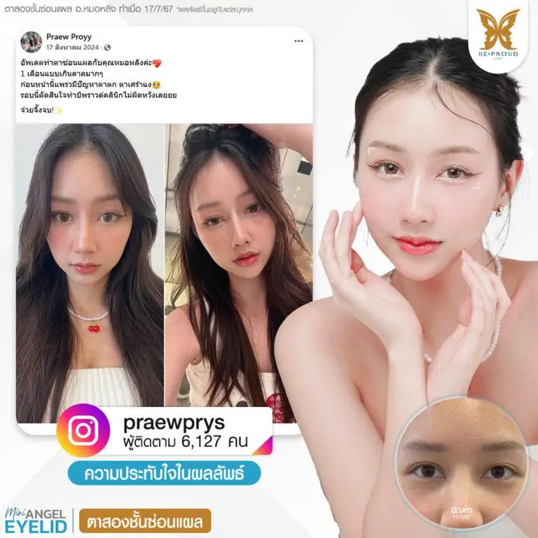 รีวิวความประทับใจศัลยกรรมตาสองชั้นซ่อนแผล แก้ตาตก ตาเศร้า คุณ @praewprys แสดงภาพก่อนทำและหลังทำศัลยกรรม กับอ.หมอหลิง ที่บีพราวด์คลินิก