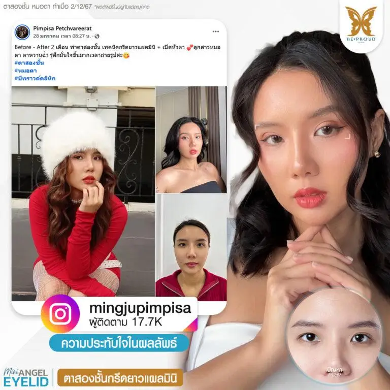 รีวิวความประทับใจศัลยกรรมตาสองชั้นกรีดยาวแผลมินิ แก้ตาดูง่วงนอน คุณ @mingjupimpisa แสดงภาพก่อนทำและหลังทำศัลยกรรม กับหมอดา ที่บีพราวด์คลินิก
