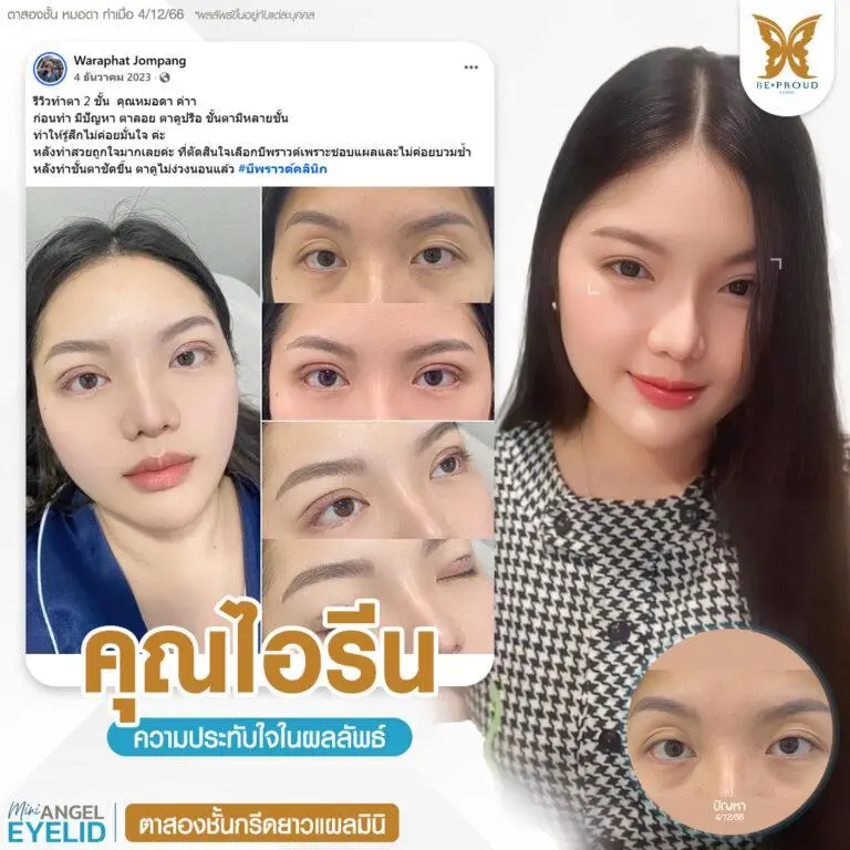 รีวิวความประทับใจศัลยกรรมตาสองชั้นกรีดยาวแผลมินิ แก้ตาดูง่วงนอน ตาลอย ตาปรือ แสดงภาพก่อนทำและหลังทำศัลยกรรม กับหมอดา ที่บีพราวด์คลินิก