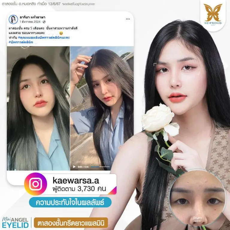 รีวิวความประทับใจศัลยกรรมตาสองชั้นกรีดยาวแผลมินิ คุณ @kaewarsa.a แสดงภาพก่อนทำและหลังทำศัลยกรรม กับอ.หมอหลิง ที่บีพราวด์คลินิก