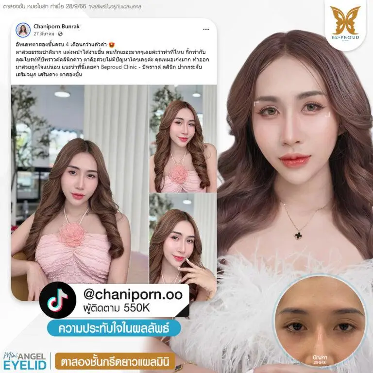 รีวิวความประทับใจศัลยกรรมตาสองชั้นกรีดยาวแผลมินิ คุณ @chaniporn.oo แสดงภาพก่อนทำและหลังทำศัลยกรรม กับหมอไบร์ท ที่บีพราวด์คลินิก
