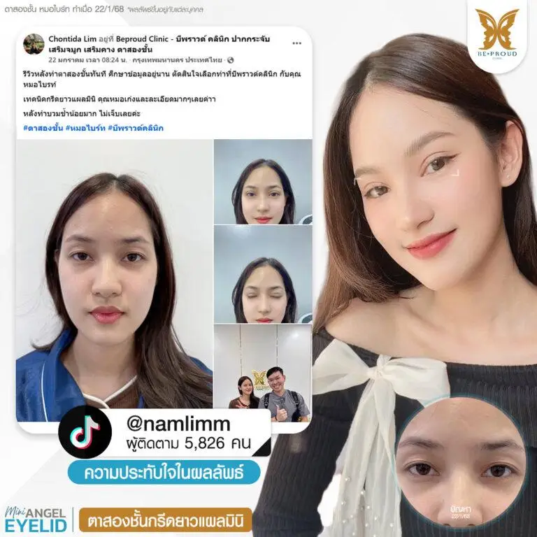 รีวิวความประทับใจศัลยกรรมตาสองชั้นกรีดยาวแผลมินิ คุณ @namlimm แสดงภาพก่อนทำและหลังทำศัลยกรรม กับหมอไบร์ท ที่บีพราวด์คลินิก