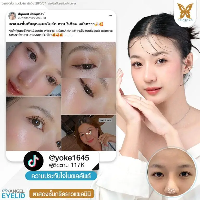 รีวิวความประทับใจศัลยกรรมตาสองชั้นกรีดยาวแผลมินิ คุณ @yoke1645 แสดงภาพก่อนทำและหลังทำศัลยกรรม กับหมอไบร์ท ที่บีพราวด์คลินิก