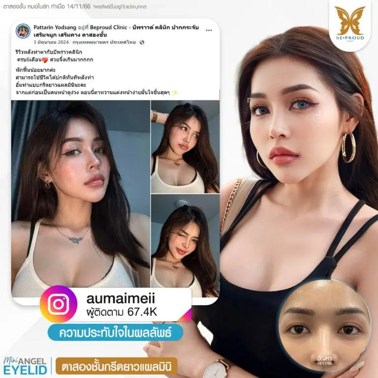 รีวิวความประทับใจศัลยกรรมตาสองชั้นกรีดยาวแผลมินิ แก้ตาดูง่วงนอน คุณ @aumaimeii แสดงภาพก่อนทำและหลังทำศัลยกรรม กับหมอไบร์ท ที่บีพราวด์คลินิก