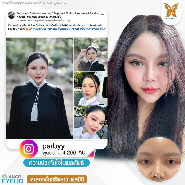 รีวิวความประทับใจศัลยกรรมตาสองชั้นกรีดยาวแผลมินิ คุณ @psrbyy แสดงภาพก่อนทำและหลังทำศัลยกรรม กับหมอไบร์ท ที่บีพราวด์คลินิก