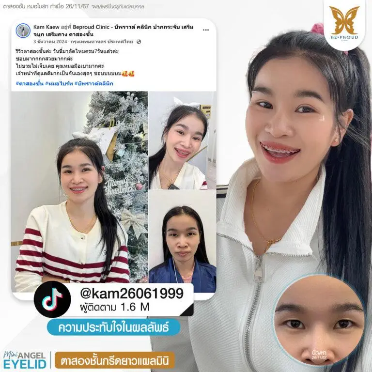 รีวิวความประทับใจศัลยกรรมตาสองชั้นกรีดยาวแผลมินิ แก้ตาดูง่วงนอน คุณ @kam26061999 แสดงภาพก่อนทำและหลังทำศัลยกรรม กับหมอไบร์ท ที่บีพราวด์คลินิก