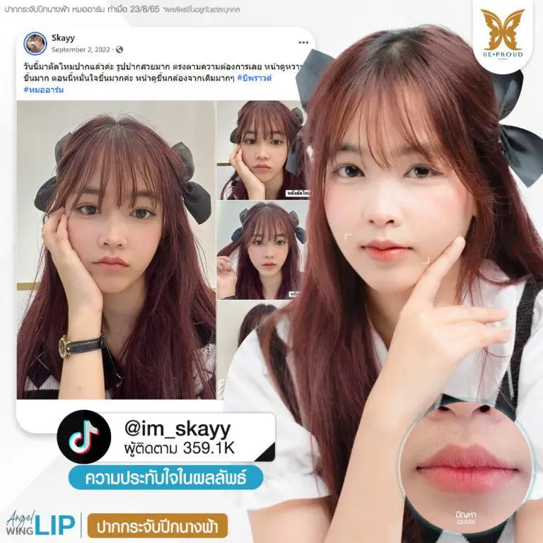 รีวิวความประทับใจศัลยกรรมปากกระจับปีกนางฟ้า คุณ @im_Skayy แสดงภาพก่อนทำและหลังทำศัลยกรรม กับหมออาร์ม ที่บีพราวด์คลินิก