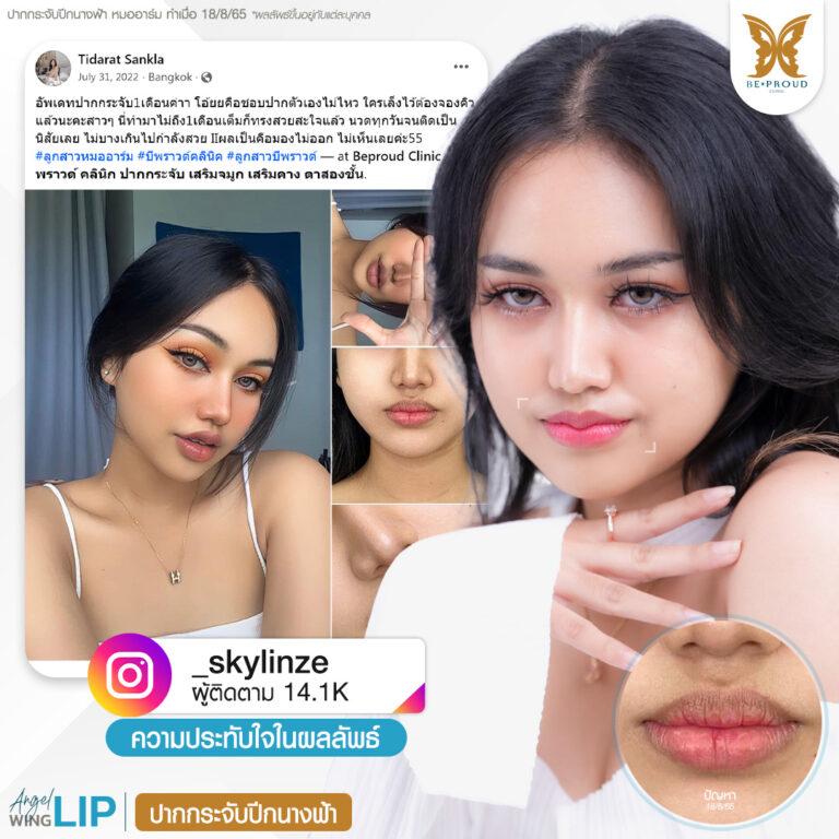 รีวิวความประทับใจศัลยกรรมปากกระจับปีกนางฟ้า คุณ @skylinze แสดงภาพก่อนทำและหลังทำศัลยกรรม กับหมออาร์ม ที่บีพราวด์คลินิก