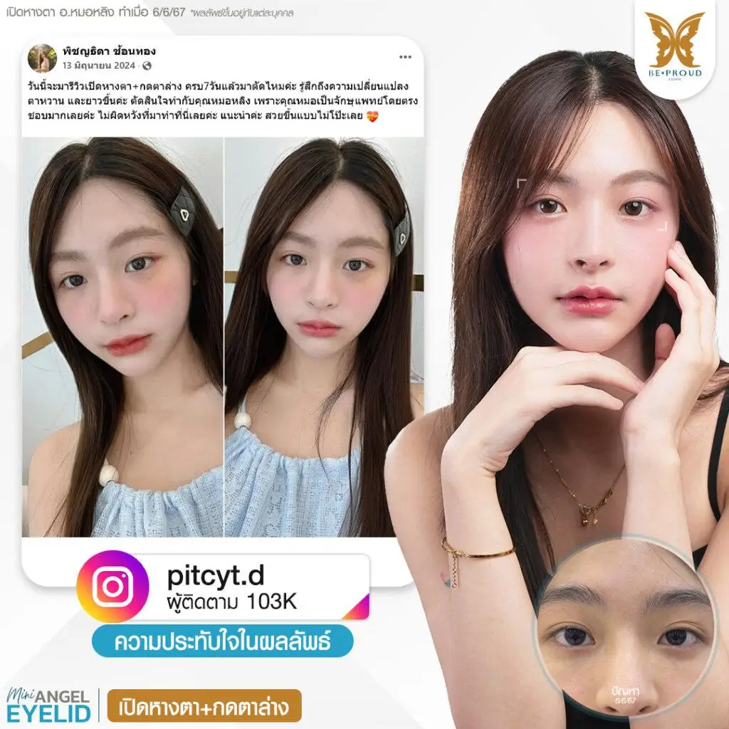 รีวิวความประทับใจศัลยกรรมเปิดหางตา กดตาล่าง คุณ @praewprys แสดงภาพก่อนทำและหลังทำศัลยกรรม กับอ.หมอหลิง ที่บีพราวด์คลินิก