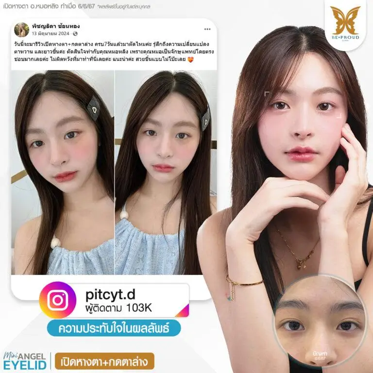 รีวิวความประทับใจศัลยกรรมเปิดหางตา กดตาล่าง คุณ @praewprys แสดงภาพก่อนทำและหลังทำศัลยกรรม กับอ.หมอหลิง ที่บีพราวด์คลินิก