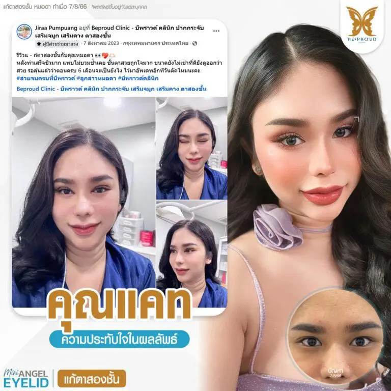 รีวิวความประทับใจศัลยกรรมแก้ตาสองชั้น แสดงภาพก่อนทำและหลังทำศัลยกรรม กับหมอดา ที่บีพราวด์คลินิก