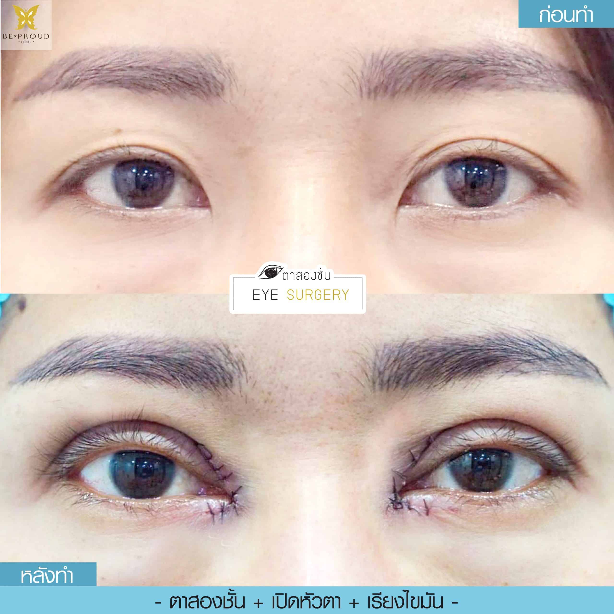 ตาสองชั้น เปิดหัวตาเรียงไขมัน