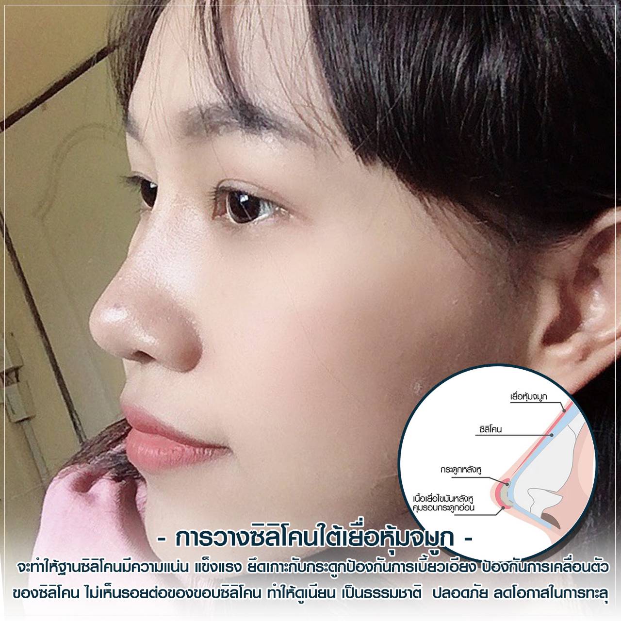 วางซิลิโคนใต้เยื่อหุ้มกระดูกจมูก