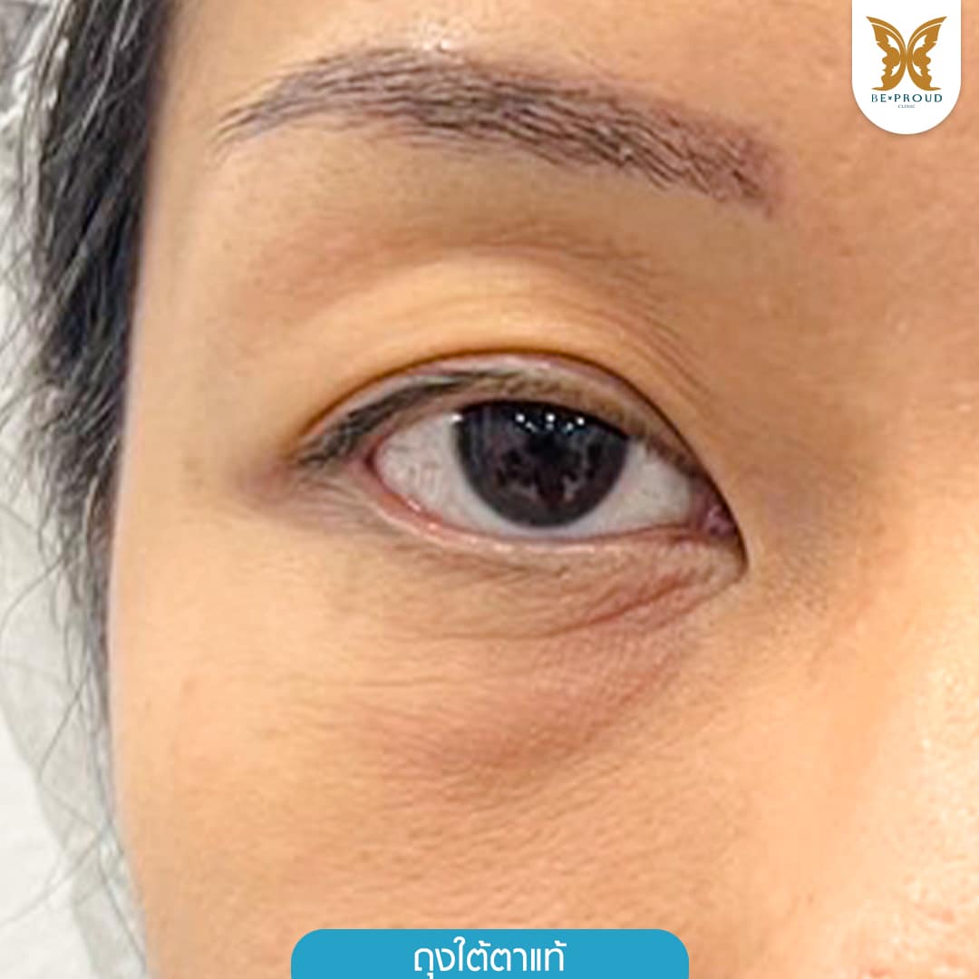 ถุงใต้ตาแท้ บีพราวด์