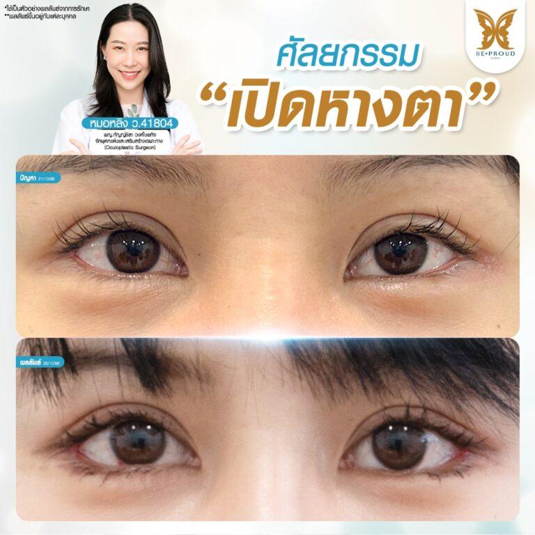 ศัลยกรรมเปิดหางตา อ.หมอหลิงบีพราวด์