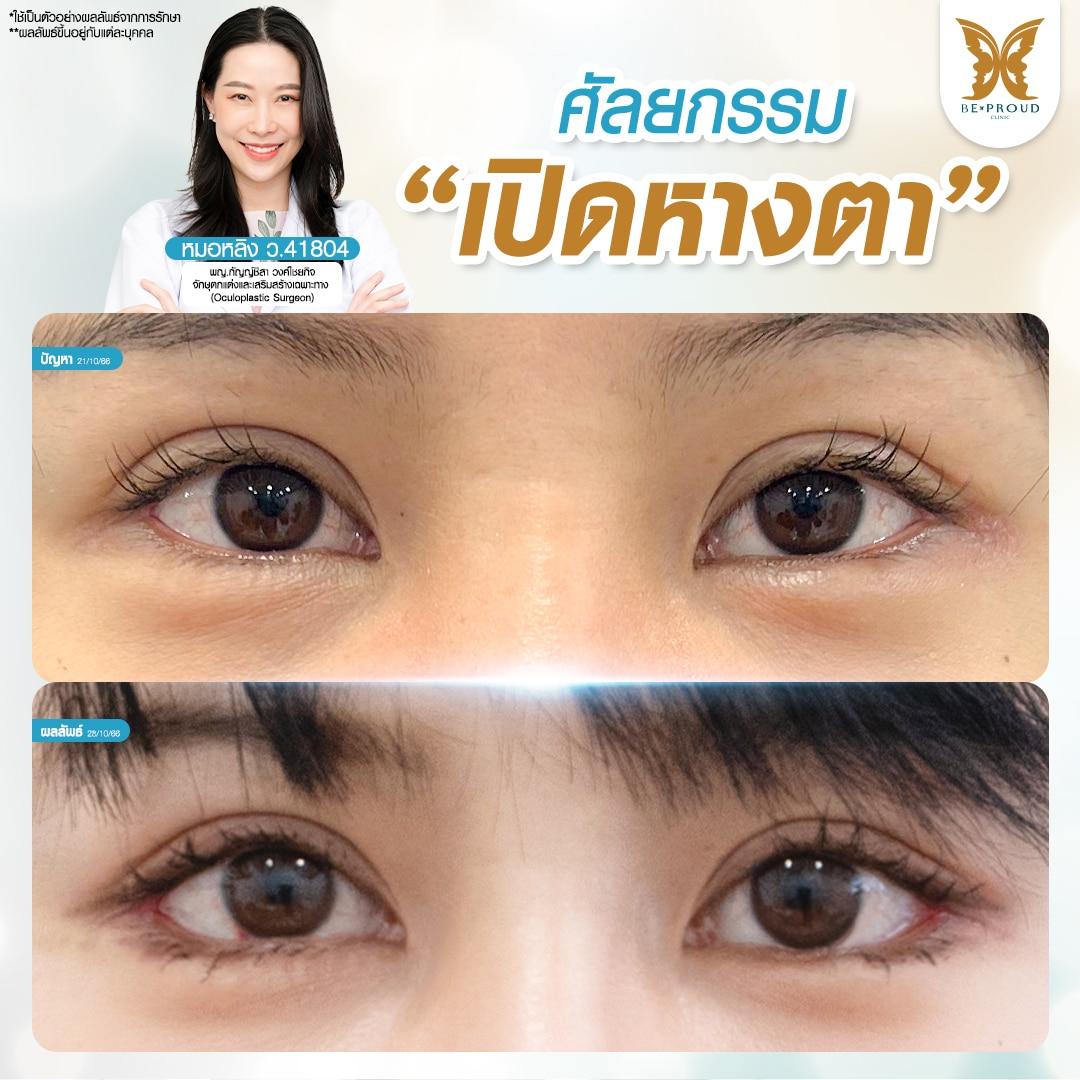 ศัลยกรรมเปิดหางตา อ.หมอหลิงบีพราวด์