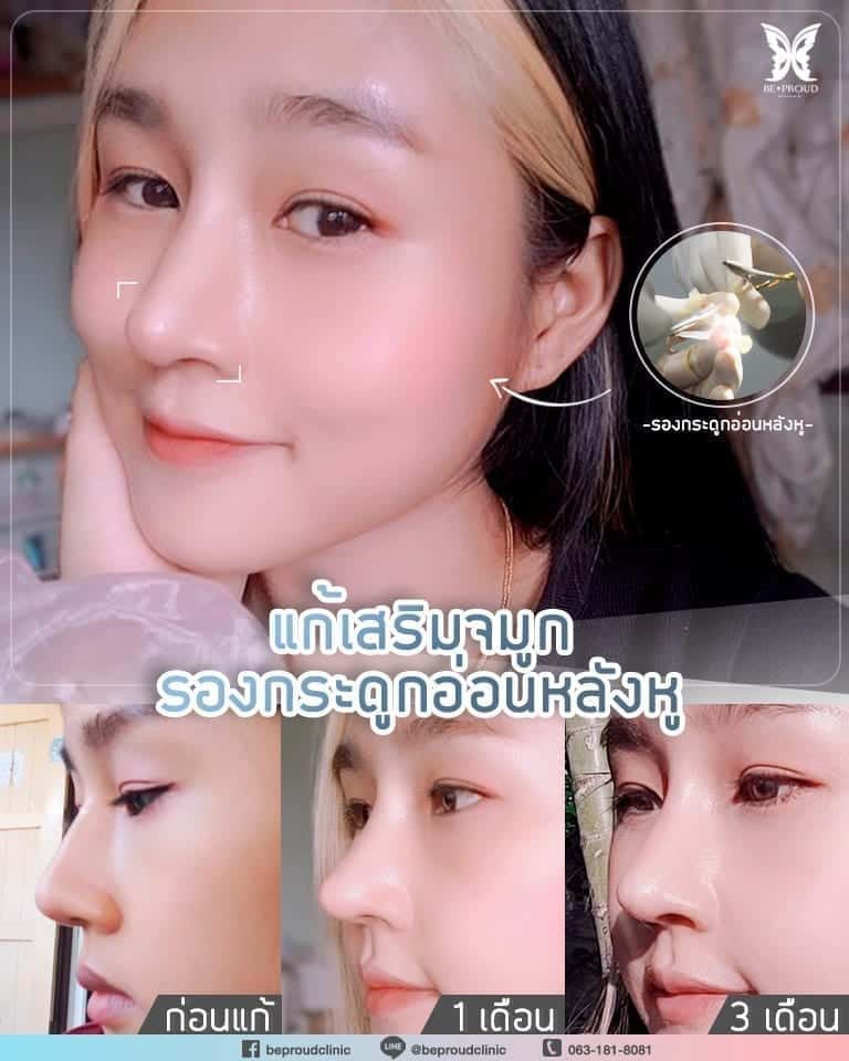 แก้เสริมจมูกรองกระดูกอ่อนหลังหู