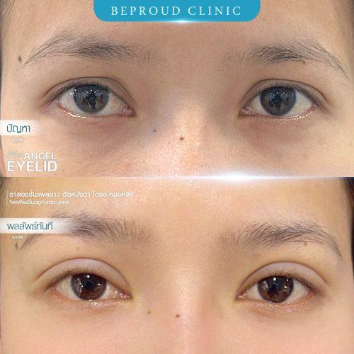 หนังตาตกทำไงดี? แก้ไขปัญหาตาปรือและเพิ่มความมั่นใจ