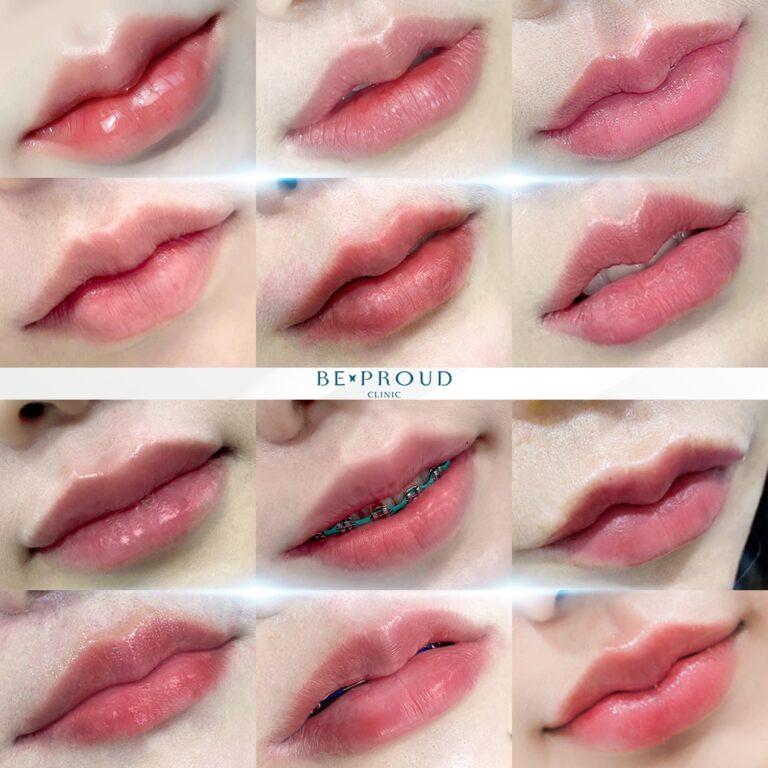 Filler Beproud Clinic
