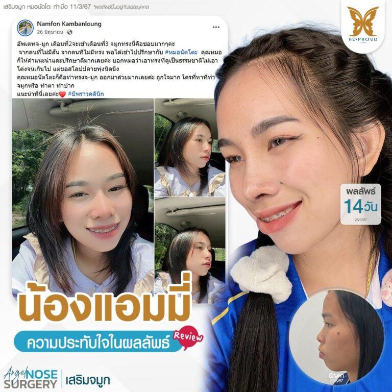 เสริมจมูก บีพราวด์