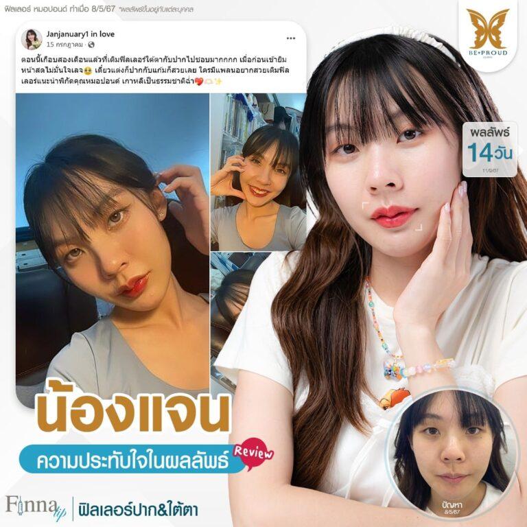 ฟิลเลอร์ปาก ใต้ตา บีพราวด์