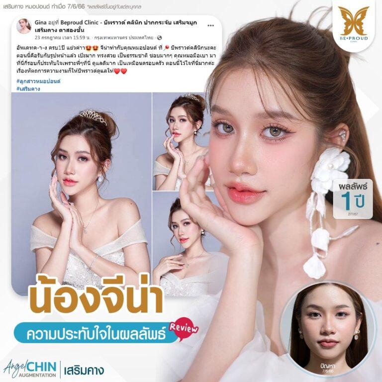 เสริมคาง บีพราวด์