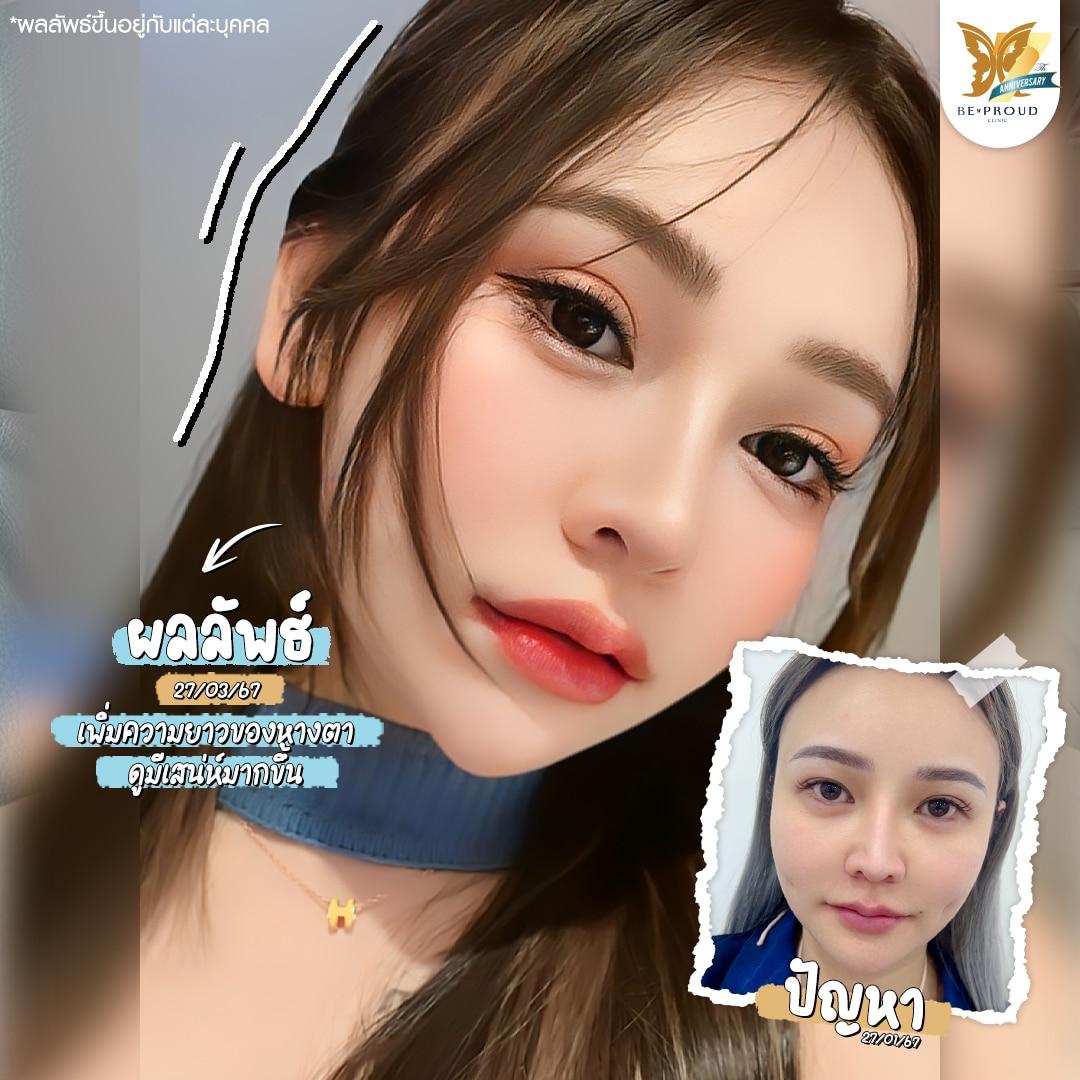 เปิดหางตา Beproud Clinic