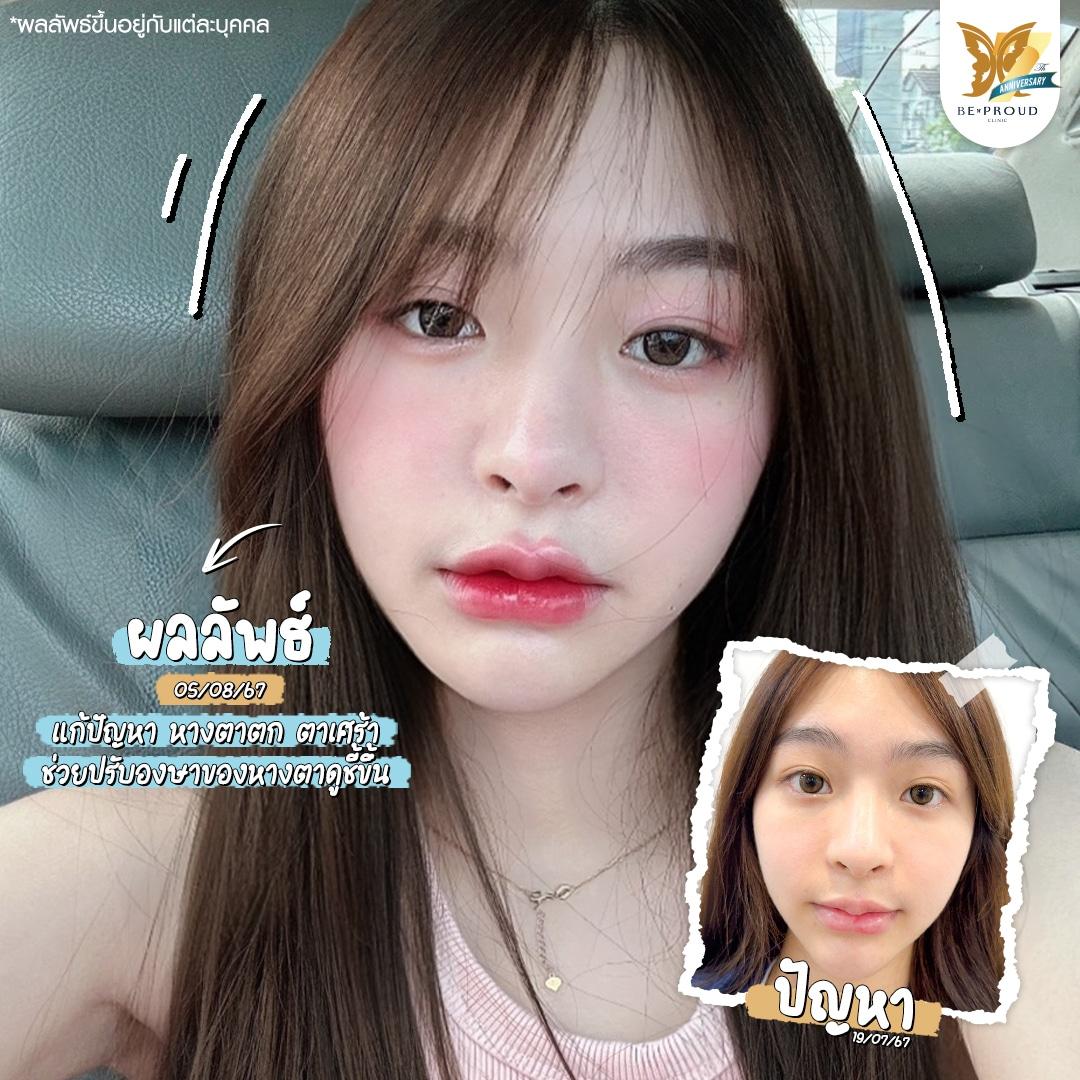 เปิดหางตา Beproud Clinic