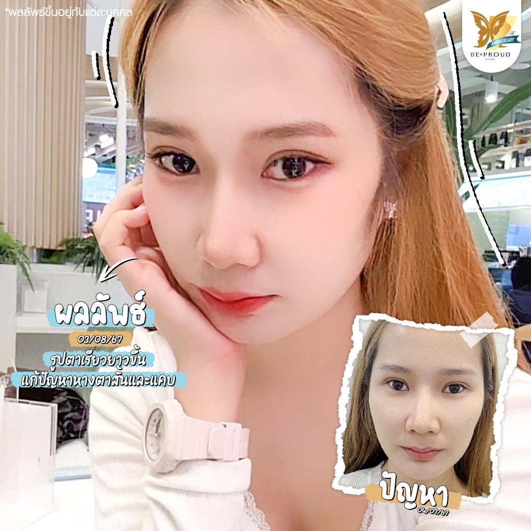 เปิดหางตา Beproud Clinic