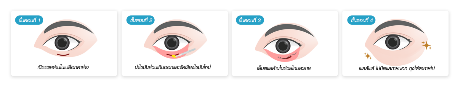 ตัดถุงใต้ตา Beproud Clinic
