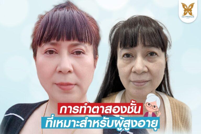 การทําตาสองชั้น สําหรับผู้สูงอายุ