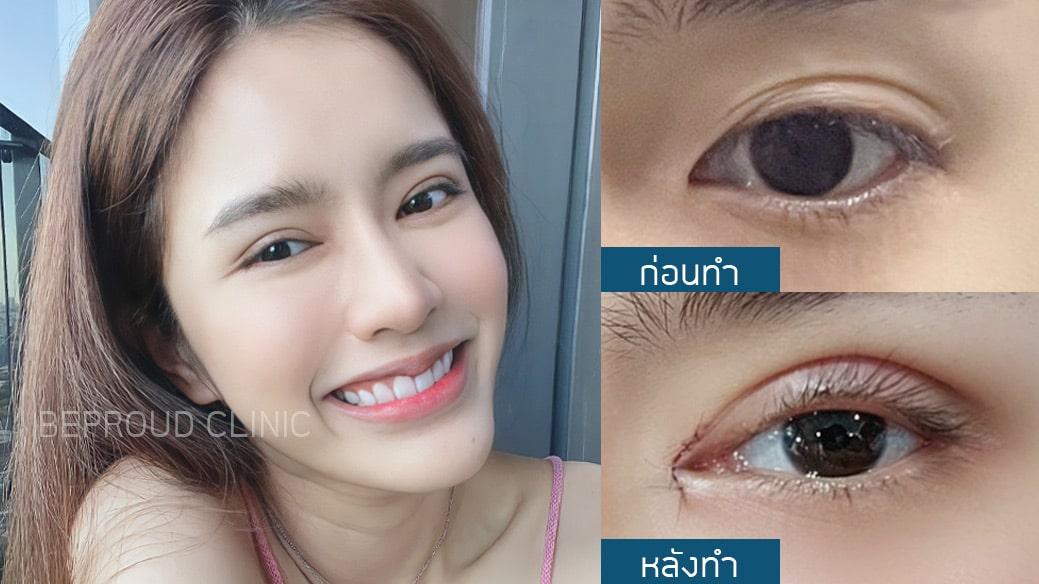 เผย "6 เทคนิคทำตาสองชั้น" ตาของเราเหมาะสมกับเทคนิคแบบไหน?