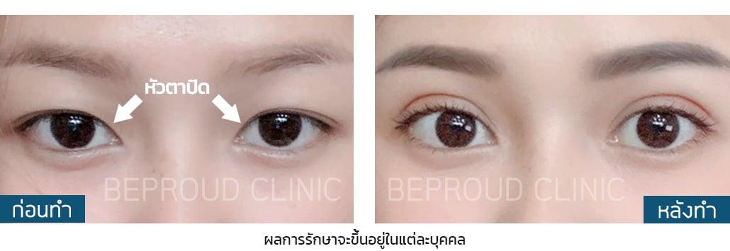 เผย "6 เทคนิคทำตาสองชั้น" ตาของเราเหมาะสมกับเทคนิคแบบไหน?