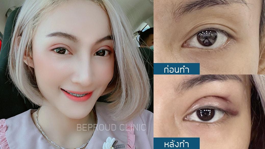 เผย "6 เทคนิคทำตาสองชั้น" ตาของเราเหมาะสมกับเทคนิคแบบไหน?