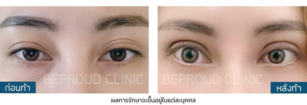 เผย "6 เทคนิคทำตาสองชั้น" ตาของเราเหมาะสมกับเทคนิคแบบไหน?